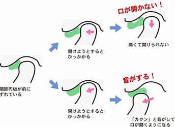 顎関節症 に対する画像結果