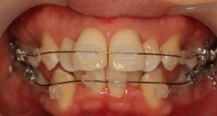歯科 ブリッジ に対する画像結果